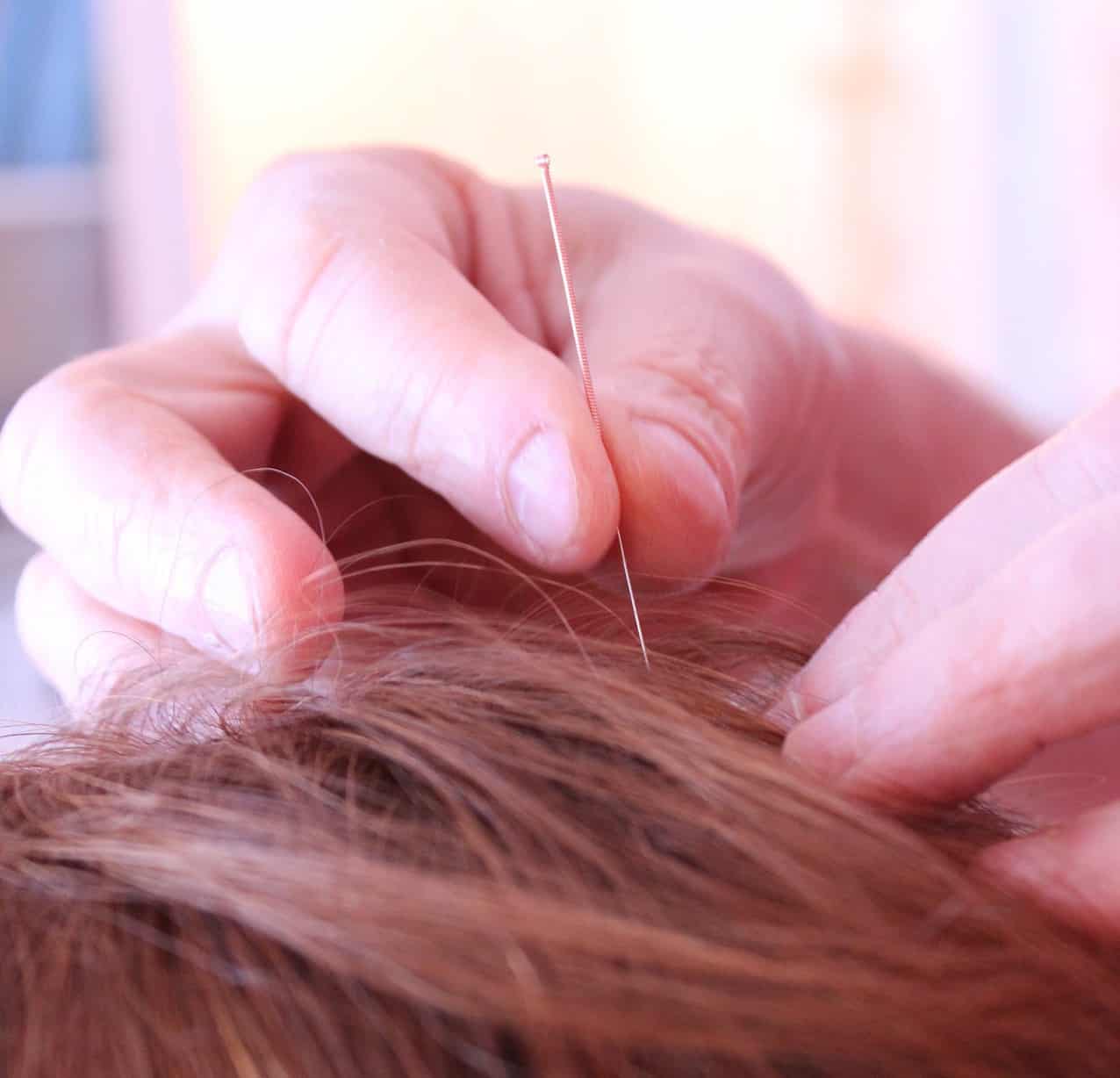 Acupuncture : prenez rendez-vous … quand vous êtes en pleine forme !